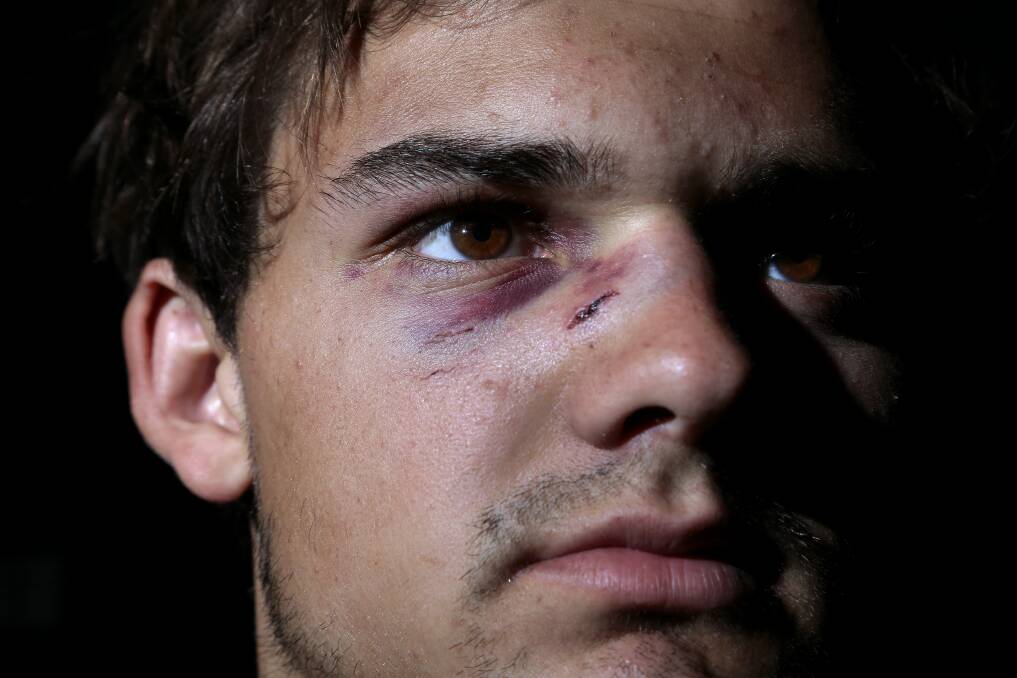 Queanbeyan Whites fourth grade player Adam Res was reportedly hit in a one-punch attack by a Wests Lions player last Saturday. Photo: Jeffrey Chan.