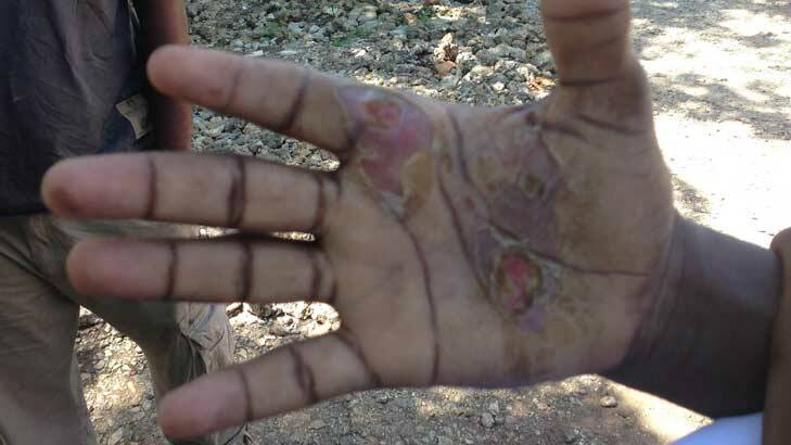 Asylum seekers had claimed that burns to hands were caused by Australian navy personnel holding their hands to hot parts of a boat engine. Photo: Supplied